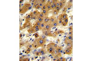 Formalin-fixed and paraffin-embedded human hepatocarcinoma reacted with CYP8B1 Antibody , which was peroxidase-conjugated to the secondary antibody, followed by DAB staining. (CYP8B1 抗体  (C-Term))