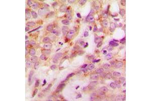 Immunohistochemical analysis of Laminin alpha 4 staining in human breast cancer formalin fixed paraffin embedded tissue section. (LAMa4 抗体  (Center))