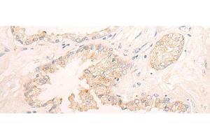 Immunohistochemistry of paraffin-embedded Human prost ate cancer tissue using ELANE Polyclonal Antibody at dilution of 1:25(x200) (ELANE 抗体)