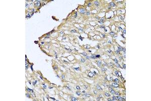 Immunohistochemistry of paraffin-embedded human prostate cancer using ASIP antibody (ABIN5974140) at dilution of 1/100 (40x lens). (ASIP 抗体)