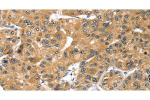 Immunohistochemistry of paraffin-embedded Human liver cancer using PRSS50 Polyclonal Antibody at dilution of 1:30 (PRSS50 抗体)