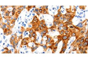 Immunohistochemistry of paraffin-embedded Human lung cancer tissue using SLC2A11 Polyclonal Antibody at dilution 1:140 (SLC2A11 抗体)