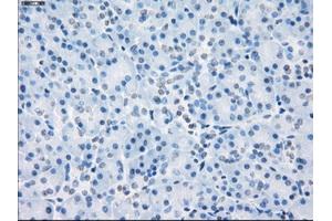 Immunohistochemical staining of paraffin-embedded Adenocarcinoma of colon tissue using anti-LTA4Hmouse monoclonal antibody. (LTA4H 抗体)
