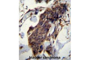 CCDC13 Antibody (N-term) immunohistochemistry analysis in formalin fixed and paraffin embedded human bladder carcinoma followed by peroxidase conjugation of the secondary antibody and DAB staining. (CCDC13 抗体  (N-Term))