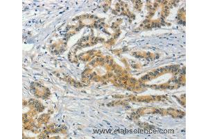 Immunohistochemistry of Human colon cancer using ASB8 Polyclonal Antibody at dilution of 1:50 (ASB8 抗体)