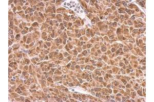 IHC-P Image PRKCSH antibody detects PRKCSH protein at cytosol on U87 xenograft by immunohistochemical analysis. (PRKCSH 抗体)