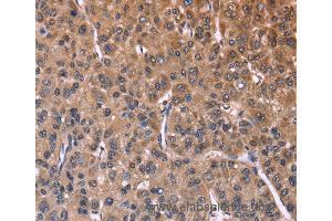 Immunohistochemistry of Human liver cancer using SEPT7 Polyclonal Antibody at dilution of 1:60 (Septin 7 抗体)