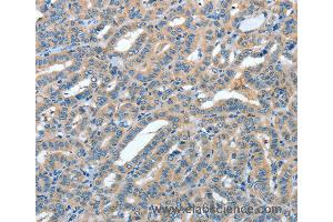 Immunohistochemistry of Human colon cancer using ANGPT1 Polyclonal Antibody at dilution of 1:50 (Angiopoietin 1 抗体)