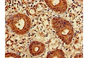 Immunohistochemistry of paraffin-embedded human colon cancer using ABIN7157550 at dilution of 1:100 (KIDINS220 抗体  (AA 1077-1370))