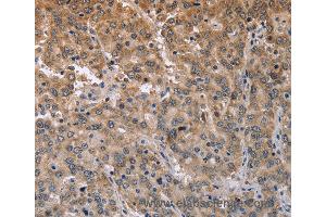 Immunohistochemistry of Human liver cancer using ECE1 Polyclonal Antibody at dilution of 1:50 (MAPRE3 抗体)
