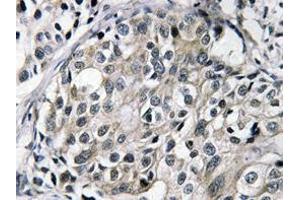 Immunohistochemistry (IHC) analyzes of TAT antibody in paraffin-embedded human breast carcinoma tissue. (HTATSF1 抗体)