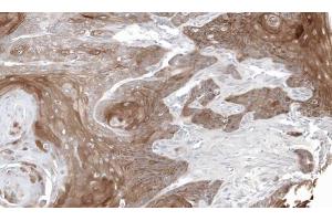 IHC-P Image Immunohistochemical analysis of paraffin-embedded Oral CA SCC25 xenograft, using TYMP, antibody at 1:100 dilution. (Thymidine Phosphorylase 抗体)