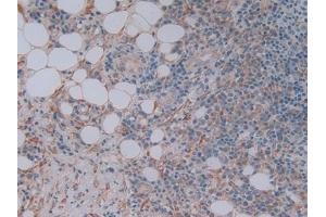 Detection of FKBP7 in Human Skin cancer Tissue using Polyclonal Antibody to FK506 Binding Protein 7 (FKBP7) (FKBP7 抗体  (AA 24-217))