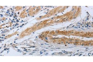 Immunohistochemistry of paraffin-embedded Human gastric cancer using NPR1 Polyclonal Antibody at dilution of 1:30 (NPR1 抗体)