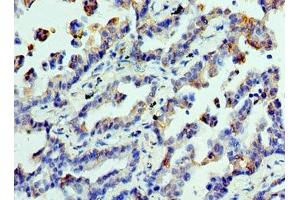 Immunohistochemistry of paraffin-embedded human lung cancer using ABIN7147858 at dilution of 1:100 (CLTA 抗体  (AA 1-218))