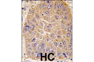 Formalin-fixed and paraffin-embedded human hepatocellular carcinoma reacted with ALDH5A1 polyclonal antibody  , which was peroxidase-conjugated to the secondary antibody, followed by DAB staining. (ALDH5A1 抗体  (N-Term))
