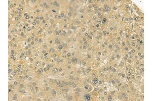 ABIN6258723 and ABIN6274903 at 1/100 staining human hepatocellular carcinoma by IHC-P. (GCNT7 抗体  (Internal Region))