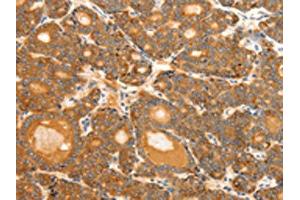 The image on the left is immunohistochemistry of paraffin-embedded Human thyroid cancer tissue using ABIN7192287(SCT Antibody) at dilution 1/40, on the right is treated with synthetic peptide. (Secretin 抗体)