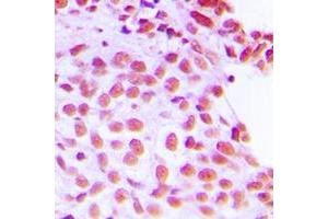 Immunohistochemical analysis of FEN1 staining in human breast cancer formalin fixed paraffin embedded tissue section. (FEN1 抗体  (Center))