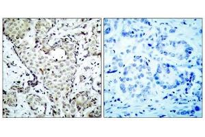 Immunohistochemical analysis of paraffin-embedded human breast carcinoma tissue, using MKK6 (Ab-207) antibody (E021153). (MAP2K6 抗体)
