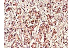 Immunohistochemistry of paraffin-embedded human pancreatic cancer using ABIN7152398 at dilution of 1:100 (FBXL22 抗体  (AA 123-229))