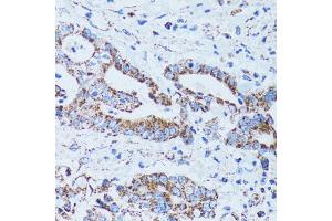 Immunohistochemistry of paraffin-embedded human colon carcinoma using GIP antibody (ABIN5973668) at dilution of 1/100 (40x lens). (GIP 抗体)