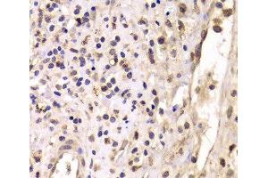 Immunohistochemistry of paraffin-embedded Human breast cancer using HDAC4 Polyclonal Antibody at dilution of 1:100 (40x lens). (HDAC4 抗体)