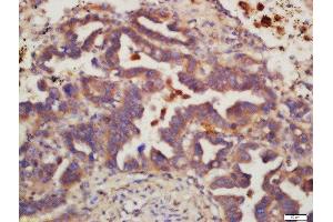 Formalin-fixed and paraffin embedded human lung carcinoma labeled with Rabbit Anti-MSH6 Polyclonal Antibody, Unconjugated 1:200 followed by conjugation to the secondary antibody and DAB staining (MSH6 抗体  (AA 812-910))