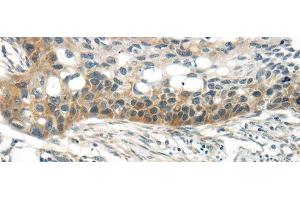 Immunohistochemistry of paraffin-embedded Human esophagus cancer tissue using WNT6 Polyclonal Antibody at dilution 1:35 (WNT6 抗体)