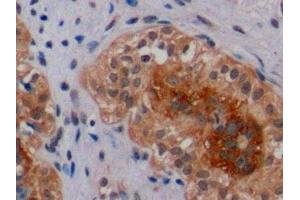 Detection of ErbB2 in Human Breast Cancer Tissue using Polyclonal Antibody to Receptor Tyrosine Protein Kinase erbB-2 (ErbB2) (ErbB2/Her2 抗体  (AA 23-372))