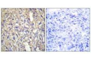 Immunohistochemistry analysis of paraffin-embedded human liver carcinoma tissue using LAMB1 antibody. (Laminin beta 1 抗体  (C-Term))