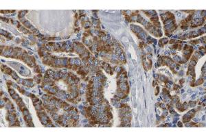 ABIN6267163 at 1/100 staining Human thyroid cancer tissue by IHC-P. (DLG2 抗体  (pTyr340))