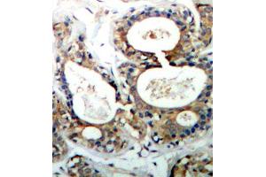 Immunohistochemistry of paraffin-embedded human breast carcinoma using Phospho-PTPN11-Y542 antibody (ABIN2987776). (PTPN11 抗体  (pTyr542))