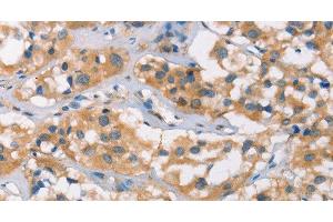 Immunohistochemistry of paraffin-embedded Human thyroid cancer tissue using DSC2 Polyclonal Antibody at dilution 1:35 (Desmocollin 2 抗体)