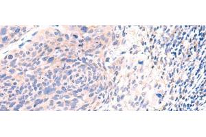 Immunohistochemistry of paraffin-embedded Human cervical cancer tissue using ESM1 Polyclonal Antibody at dilution of 1:50(x200) (ESM1 抗体)