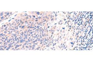 Immunohistochemistry of paraffin-embedded Human cervical cancer tissue using ESM1 Polyclonal Antibody at dilution of 1:50(x200)