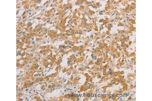 Immunohistochemistry of Human colon cancer using ZWINT Polyclonal Antibody at dilution of 1:50 (ZWINT 抗体)