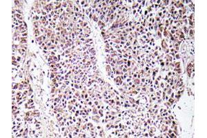 Immunohistochemical analysis of paraffin-embedded human liver carcinoma tissue using GDF9 polyclonal antibody . (GDF9 抗体)