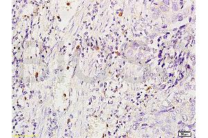 Formalin-fixed and human glioma tissue labeled with Anti-MSR1/CD204 Polyclonal Antibody, Unconjugated (ABIN872905) at 1:200 followed by conjugation to the secondary antibody and DAB staining (Macrophage Scavenger Receptor 1 抗体  (AA 211-320))