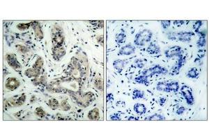 Immunohistochemical analysis of paraffin-embedded human breast carcinoma tissue using BAD(Phospho-Ser136) Antibody(left) or the same antibody preincubated with blocking peptide(right). (BAD 抗体  (pSer136))