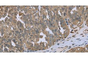 Immunohistochemistry of paraffin-embedded Human ovarian cancer tissue using DCTN4 Polyclonal Antibody at dilution 1:50 (Dynactin 4 抗体)