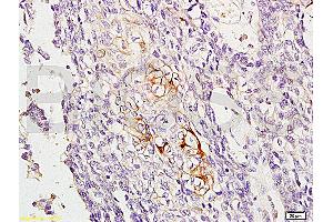 Formalin-fixed and paraffin embedded human esophageal carcinoma labeled with Anti-RAB8 Polyclonal Antibody, Unconjugated (ABIN715316) at 1:200, followed by conjugation to the secondary antibody and DAB staining
