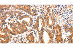 Immunohistochemistry of paraffin-embedded Human gasrtic cancer tissue using AK5 Polyclonal Antibody at dilution 1:60 (Adenylate Kinase 5 抗体)
