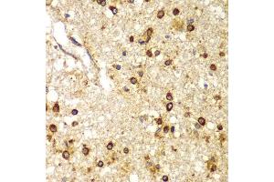 Immunohistochemistry of paraffin-embedded human brain cancer using SMAD9 antibody (ABIN5975592) at dilution of 1/100 (40x lens). (SMAD9 抗体)