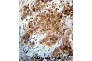 FOXO3 Antibody (N-term) (ABIN657229 and ABIN2846331) immunohistochemistry analysis in formalin fixed and paraffin embedded human breast carcinoma followed by peroxidase conjugation of the secondary antibody and DAB staining. (FOXO3 抗体  (N-Term))