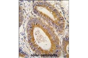 Formalin-fixed and paraffin-embedded human colon carcinoma tissue reacted with YARS2 antibody (N-term) (ABIN6244048 and ABIN6579016) , which was peroxidase-conjugated to the secondary antibody, followed by DAB staining. (YARS2 抗体  (N-Term))
