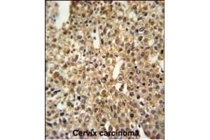 DEN1A Antibody (C-term) (ABIN653873 and ABIN2843124) IHC analysis in formalin fixed and paraffin embedded human cervix carcinoma followed by peroxidase conjugation of the secondary antibody and DAB staining. (DENND1A 抗体  (C-Term))