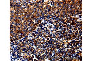 Immunohistochemistry of Human lung cancer using IL13RA1 Polyclonal Antibody at dilution of 1:50 (IL13 Receptor alpha 1 抗体)