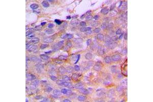 Immunohistochemical analysis of CRABP2 staining in human breast cancer formalin fixed paraffin embedded tissue section. (CRABP2 抗体  (Center))