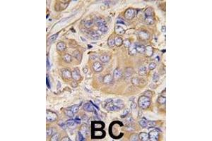 Formalin-fixed and paraffin-embedded human breast carcinoma tissue reacted with HSPB1 Antibody (S78) (ABIN391298 and ABIN2841334) , which was peroxidase-conjugated to the secondary antibody, followed by DAB staining. (HSP27 抗体  (AA 56-85))